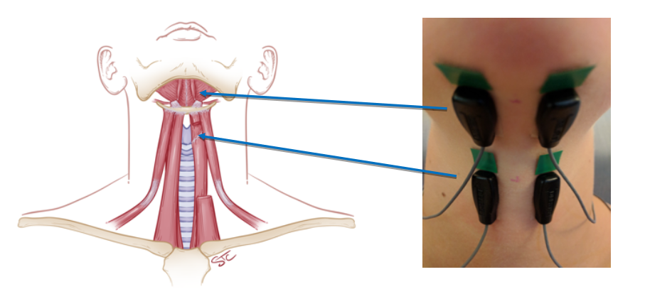 Delsys Electrodes Placement